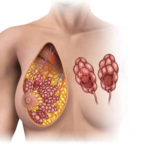 Clinical Pathology: Benign Breast Diseases (Mastitis, Fibrocystic