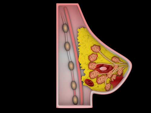fibroadenomas